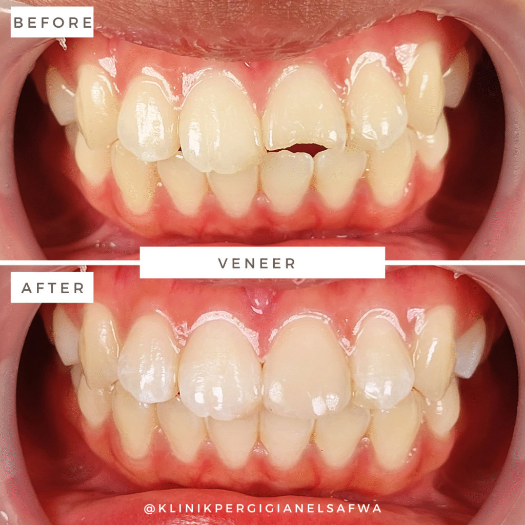 ElSafwa-veneer-before-after (1)