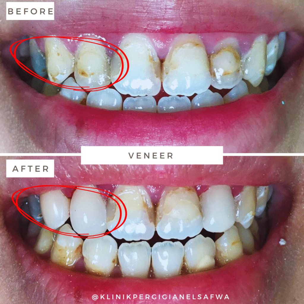 ElSafwa-veneer-before-after (14)