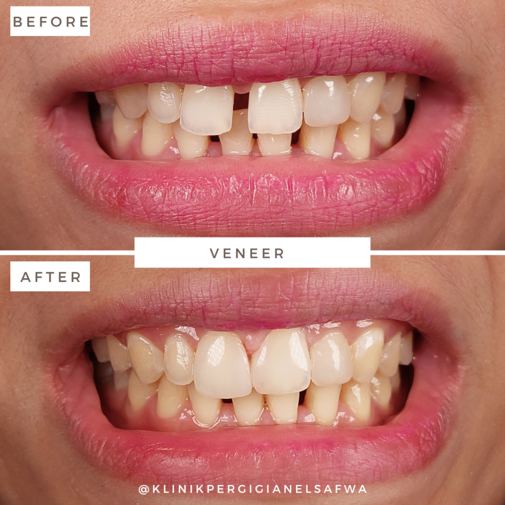 ElSafwa-veneer-before-after (5)