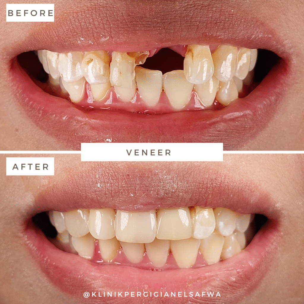 ElSafwa-veneer-before-after (6)