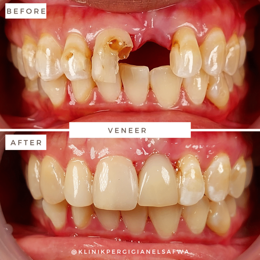 ElSafwa-veneer-before-after (8)