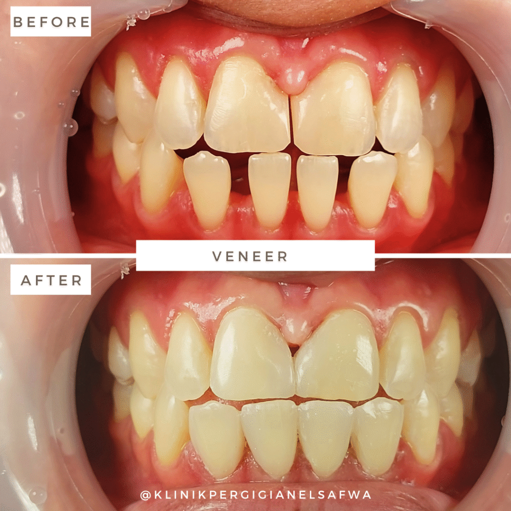 ElSafwa-veneer-before-after (9)